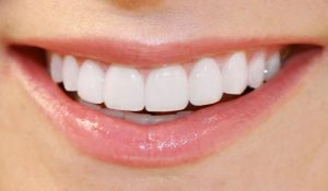 Dental veneers