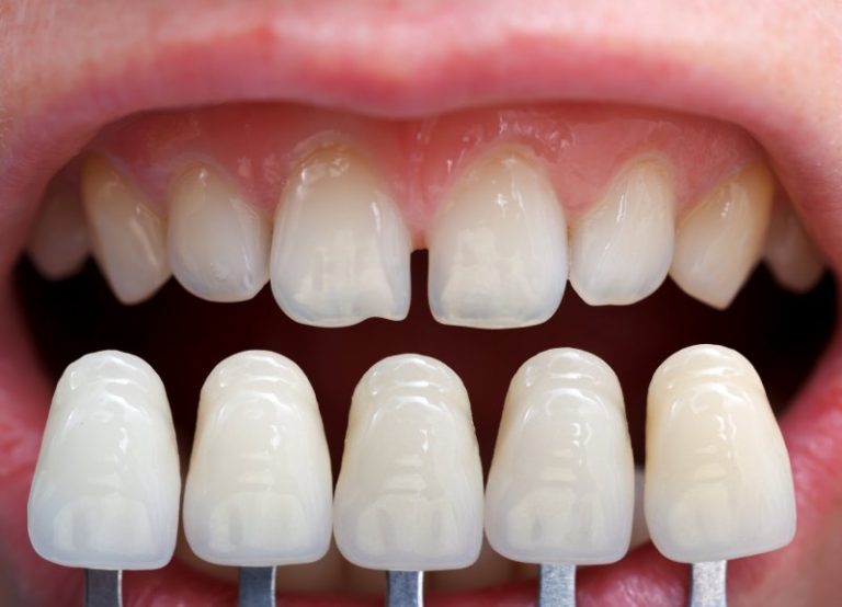 Dental veneers the best way to close your teeth's gaps