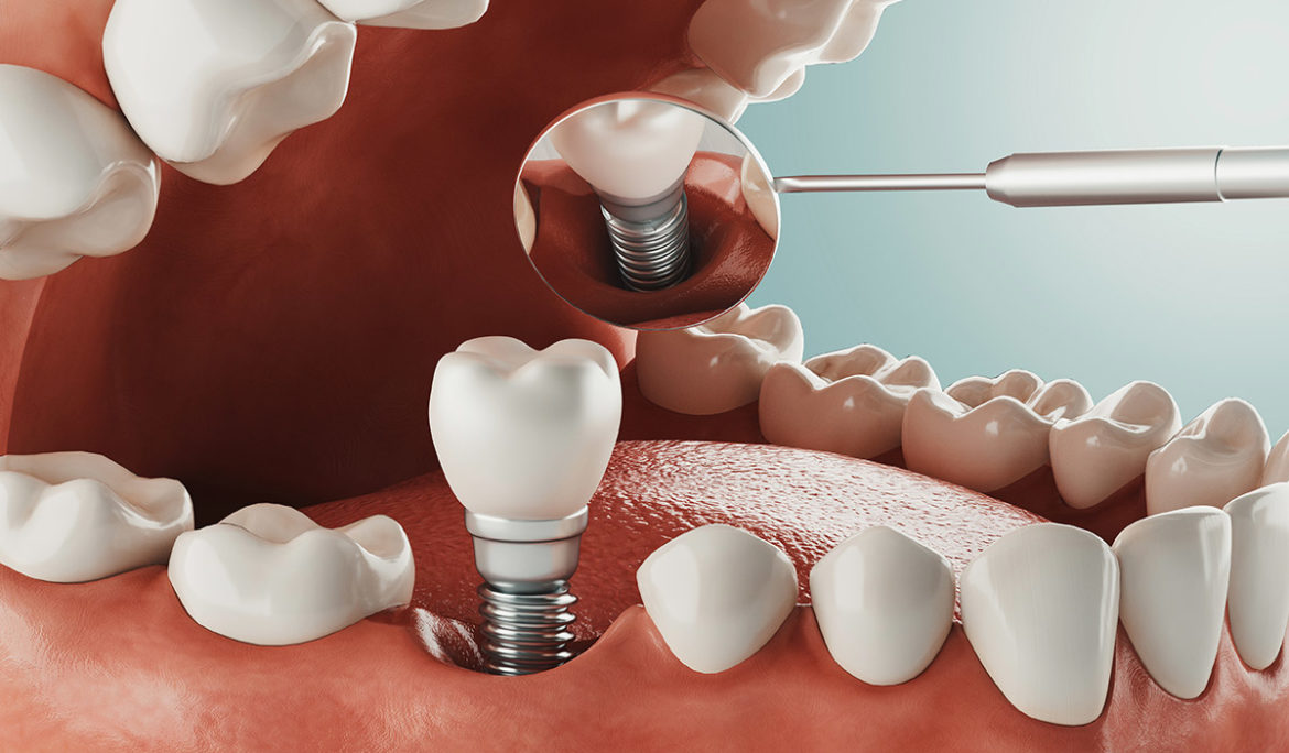 How dental implants works? Matizz Veneers Official